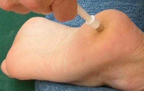 biopsy